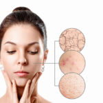 Ako na nedokonalosti pleti?